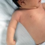 Brachial Plexus Injuries in Newborns (Erb’s Palsy)