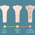 Osteoporosis: What are the conditions in which the risk of developing it increases?