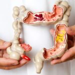 Irritable Bowel Syndrome (IBS)