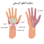 خدر وألم في اليد… لا تتجاهله! تعرف على متلازمة النفق الرسغي ‏(Carpal Tunnel Syndrome – CTS)