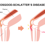 مرض أوسگود-شلاتر‏(Osgood-Schlatter Disease) دليلك الشامل لفهم آلام النمو عند ابنك المراهق الرياضي