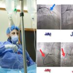 تدخل قسطاري طارئ ينقذ أربعينيًا من جلطة قلبية حادة