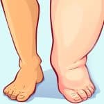 الليمفديما (الوذمة اللمفية): الأسباب، الأعراض، وطرق العلاج