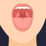حصوات اللوزتين: الأسباب، الأعراض، وطرق العلاج