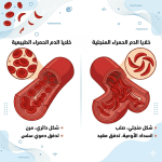 فقر الدم المنجلي: مرض وراثي يؤثر على خلايا الدم الحمراء